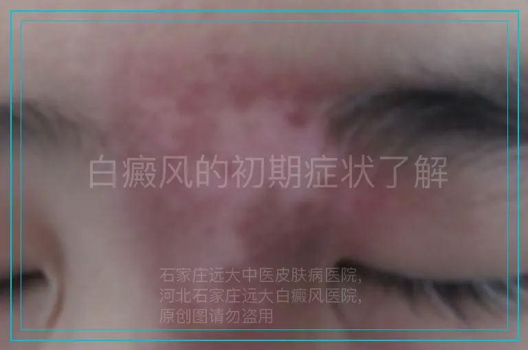 白癜风的初期症状了解