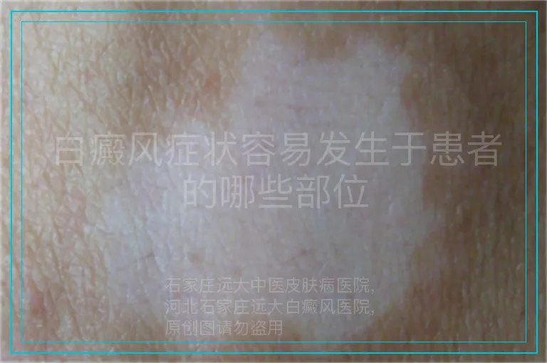 白癜风症状容易发生于患者的哪些部位