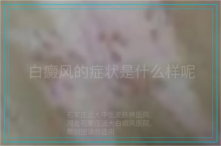 白癜风的症状是什么样呢