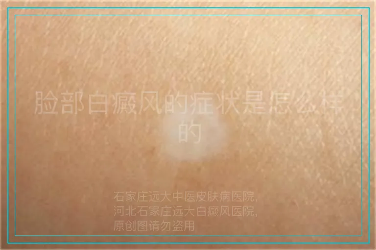 脸部白癜风的症状是怎么样的