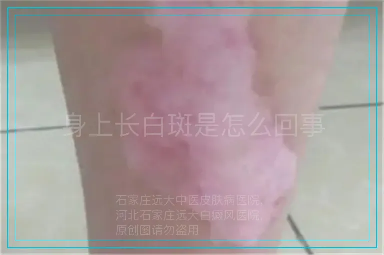 身上长白斑是怎么回事