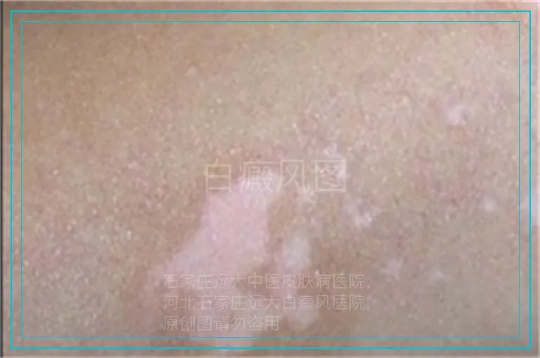 白癜风图
