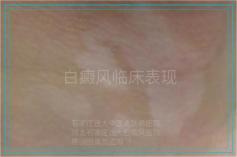 白癜风临床表现