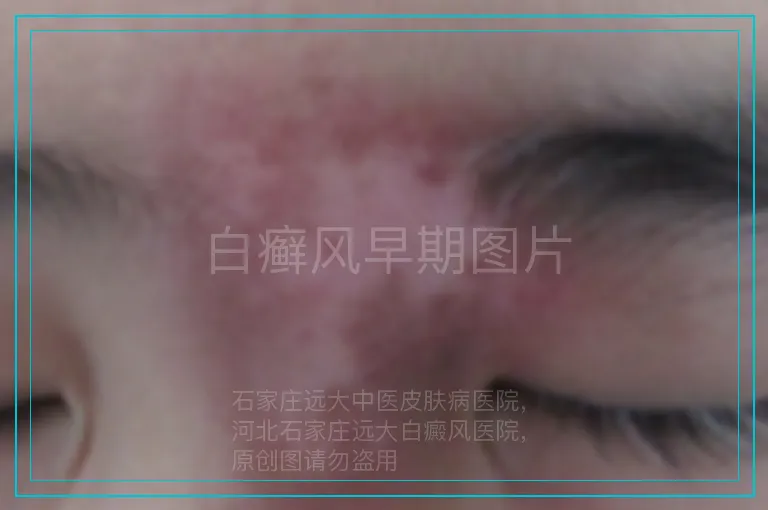 白癣风早期图片