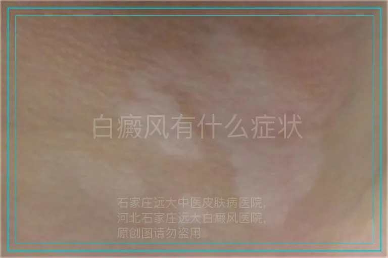 白癜风有什么症状