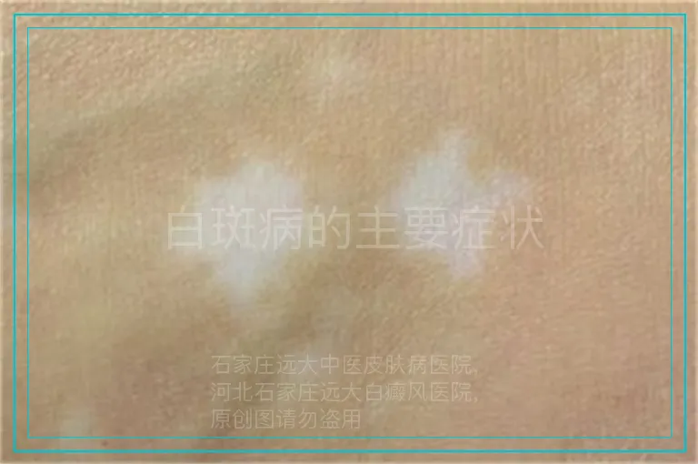 白斑病的主要症状