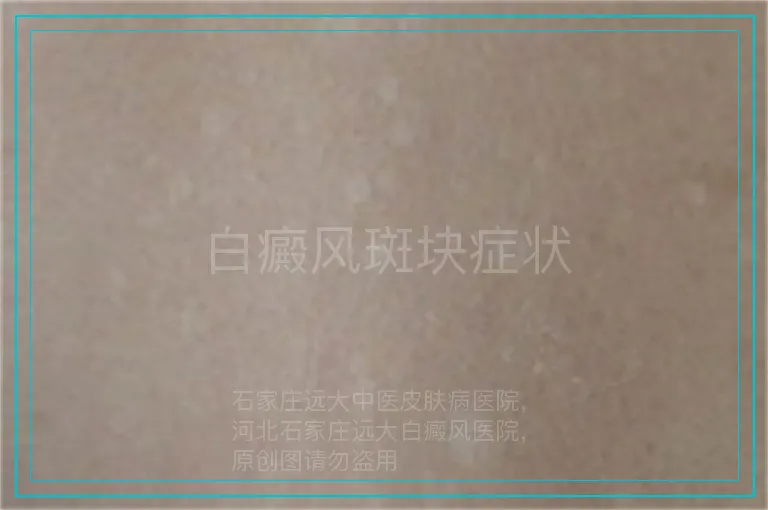 白癜风斑块症状