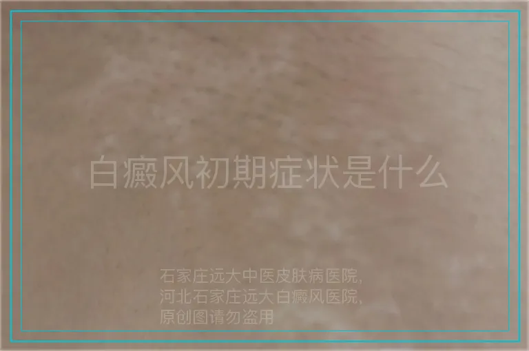白癜风初期症状是什么