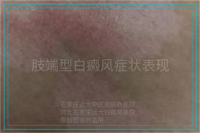 肢端型白癜风症状表现