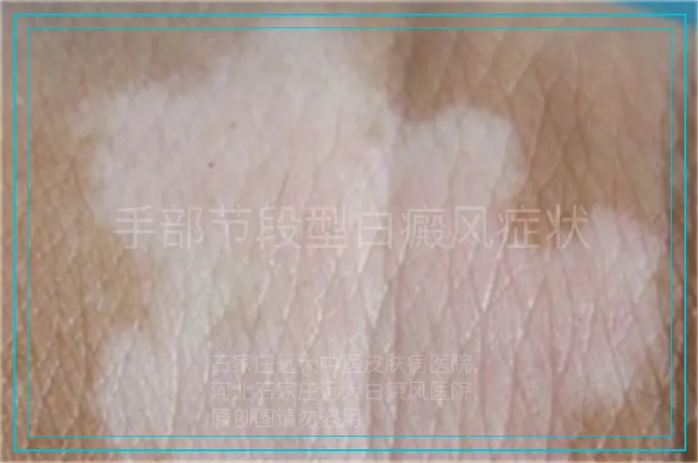 手部节段型白癜风症状