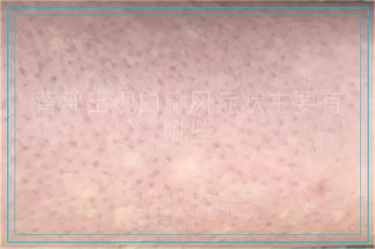 背部出现白癜风症状主要有哪些