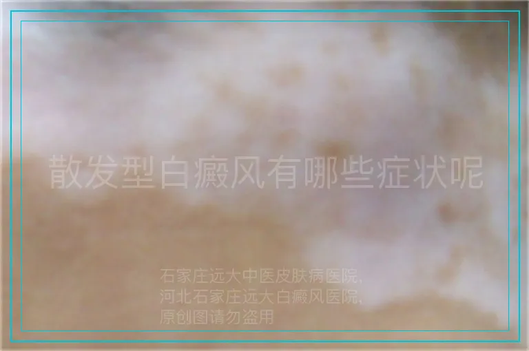 散发型白癜风有哪些症状呢