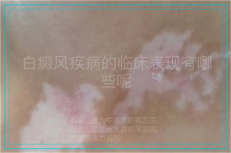 白癜风疾病的临床表现有哪些呢