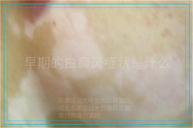 早期的白癜风症状是什么