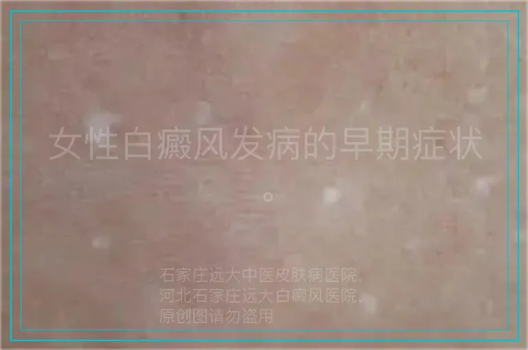 女性白癜风发病的早期症状。