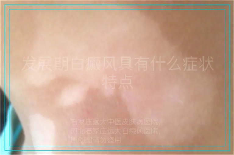 发展期白癜风具有什么症状特点