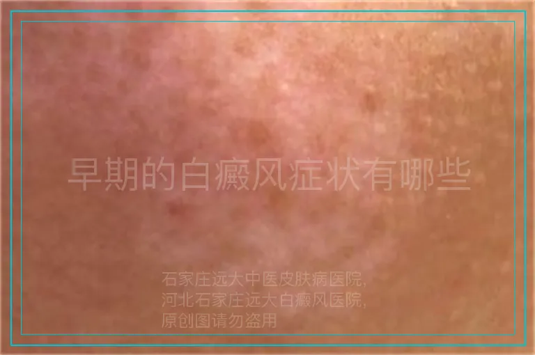 早期的白癜风症状有哪些