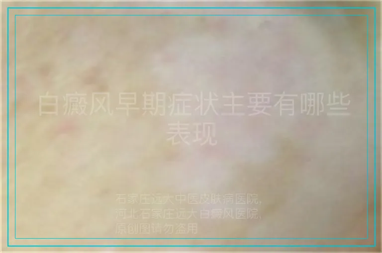 白癜风早期症状主要有哪些表现