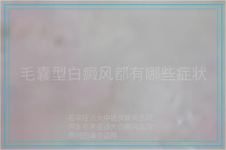 毛囊型白癜风都有哪些症状