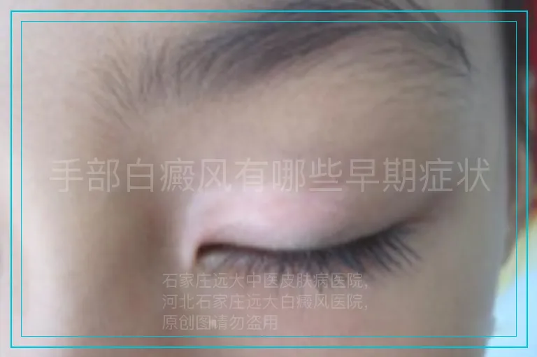 手部白癜风有哪些早期症状