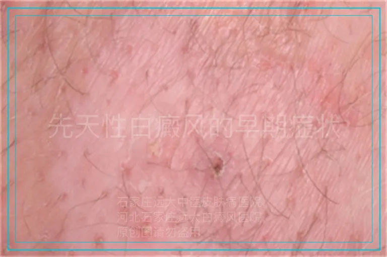 先天性白癜风的早期症状