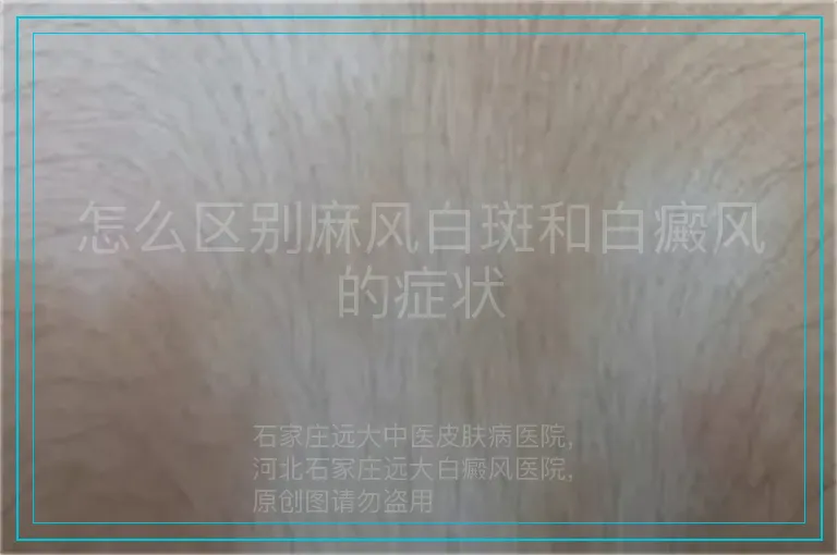 怎么区别麻风白斑和白癜风的症状