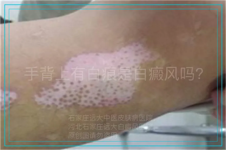 手背上有白痕是白癜风吗?