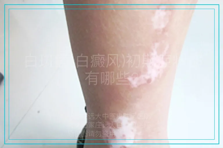 白斑病(白癜风)初期症状都有哪些?