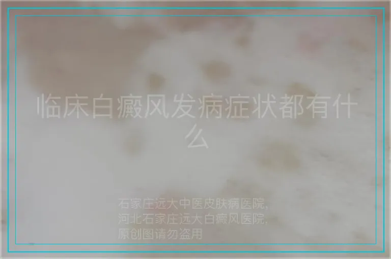 临床白癜风发病症状都有什么