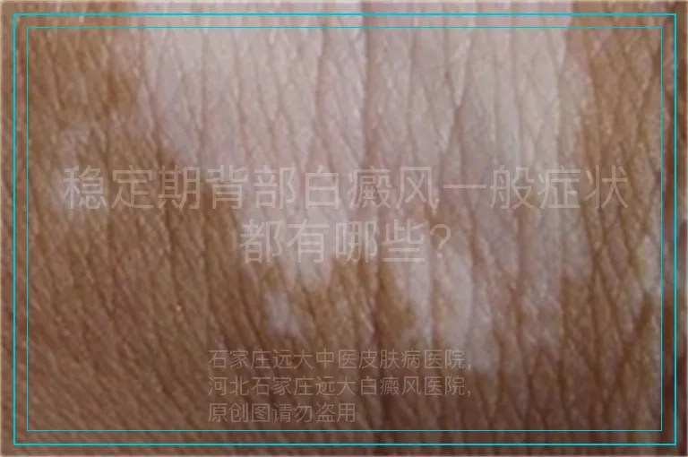 稳定期背部白癜风一般症状都有哪些?