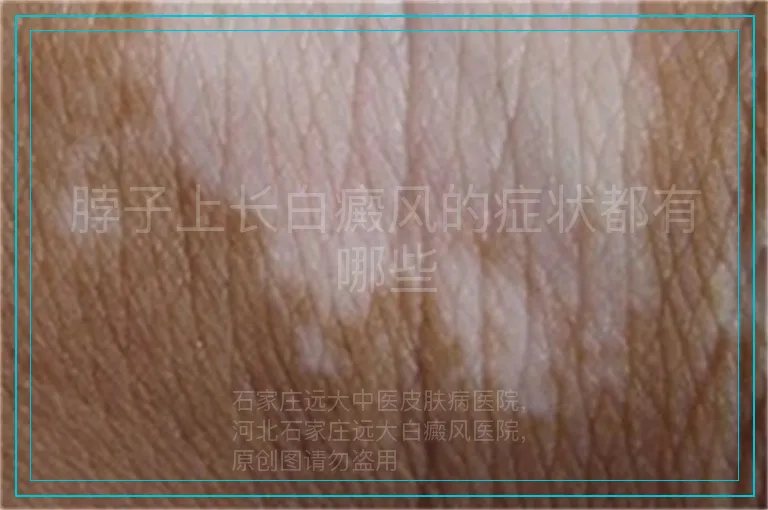 脖子上长白癜风的症状都有哪些