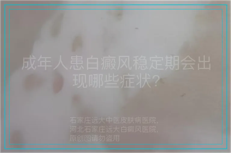 成年人患白癜风稳定期会出现哪些症状?