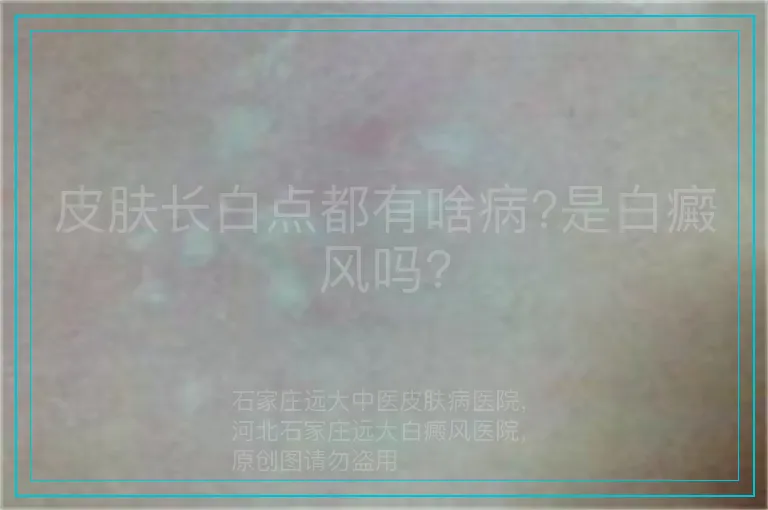 皮肤长白点都有啥病?是白癜风吗?