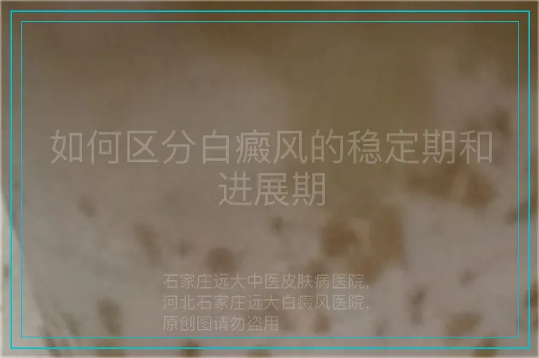 如何区分白癜风的稳定期和进展期