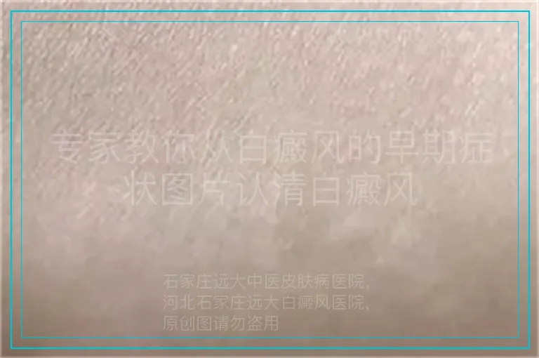 专家教你从白癜风的早期症状图片认清白癜风