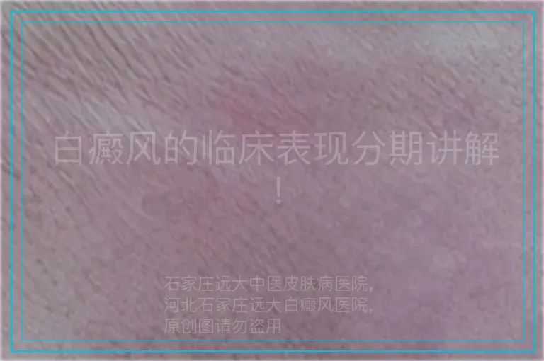 白癜风的临床表现分期讲解！