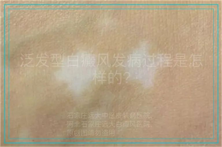 泛发型白癜风发病过程是怎样的?