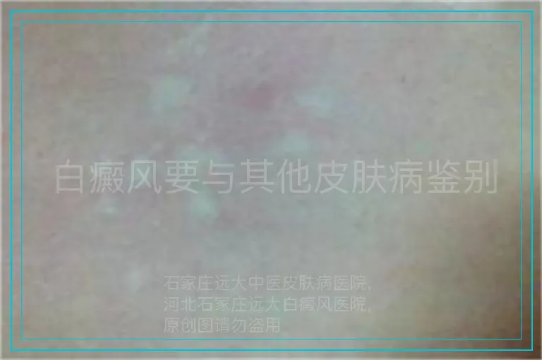 白癜风要与其他皮肤病鉴别