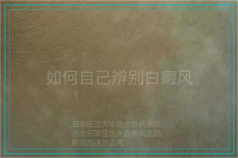 如何自己辨别白癜风
