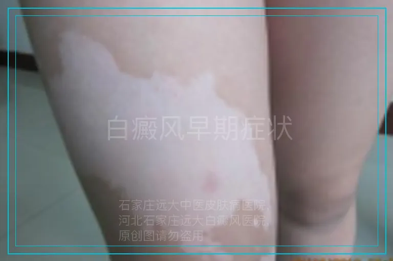 白癜风早期症状