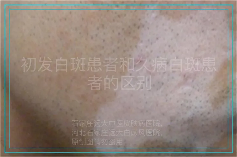 初发白斑患者和久病白斑患者的区别
