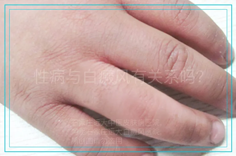 性病与白癜风有关系吗？