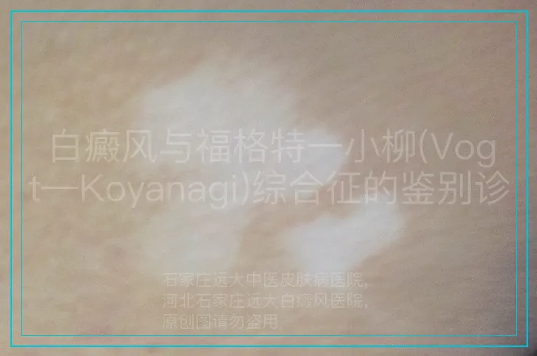 白癜风与福格特一小柳(Vogt—Koyanagi)综合征的鉴别诊断