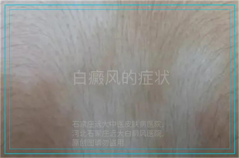 白癜风的症状