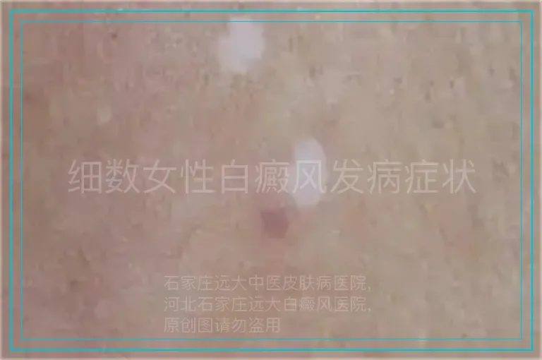 细数女性白癜风发病症状