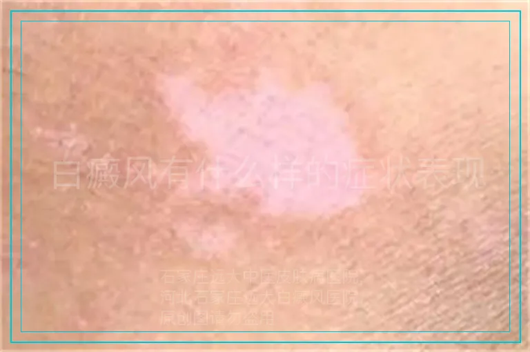 白癜风有什么样的症状表现