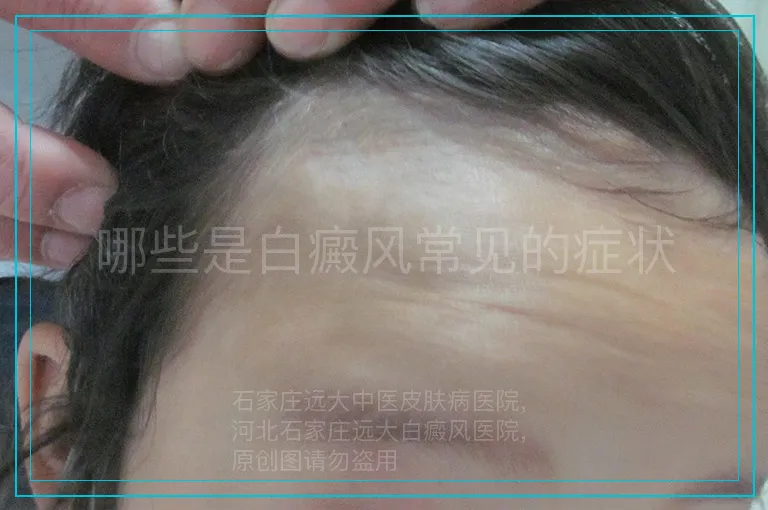 哪些是白癜风常见的症状