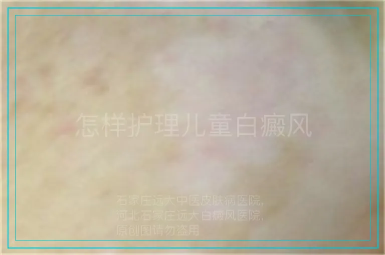 怎样护理儿童白癜风