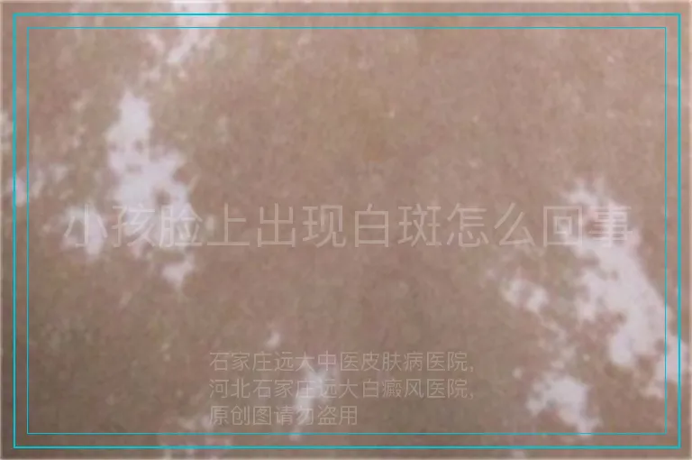 小孩脸上出现白斑怎么回事