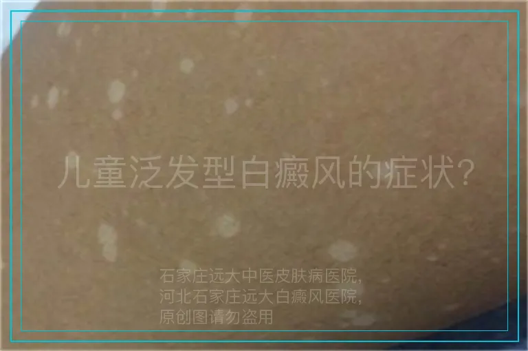 儿童泛发型白癜风的症状?